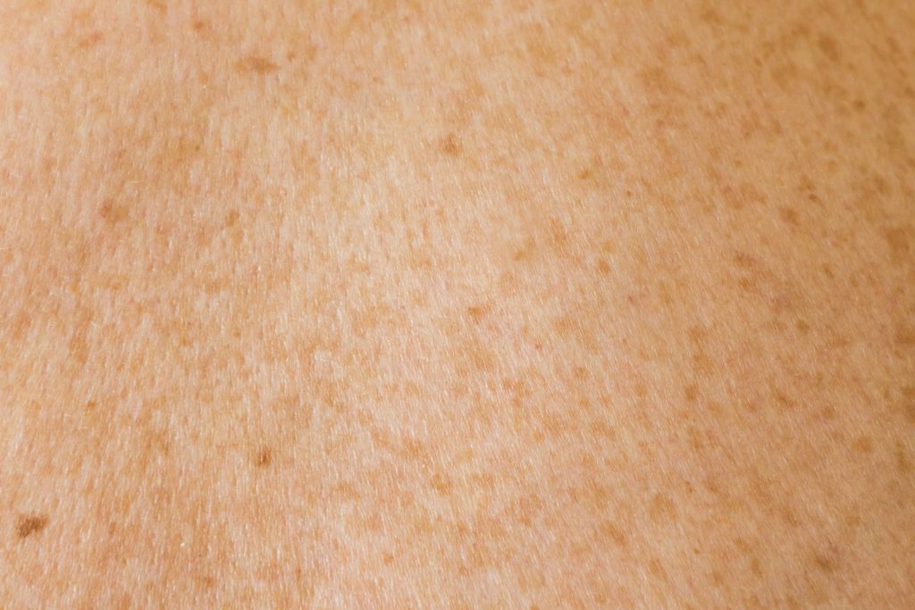 a close up of a person's back with brown spots